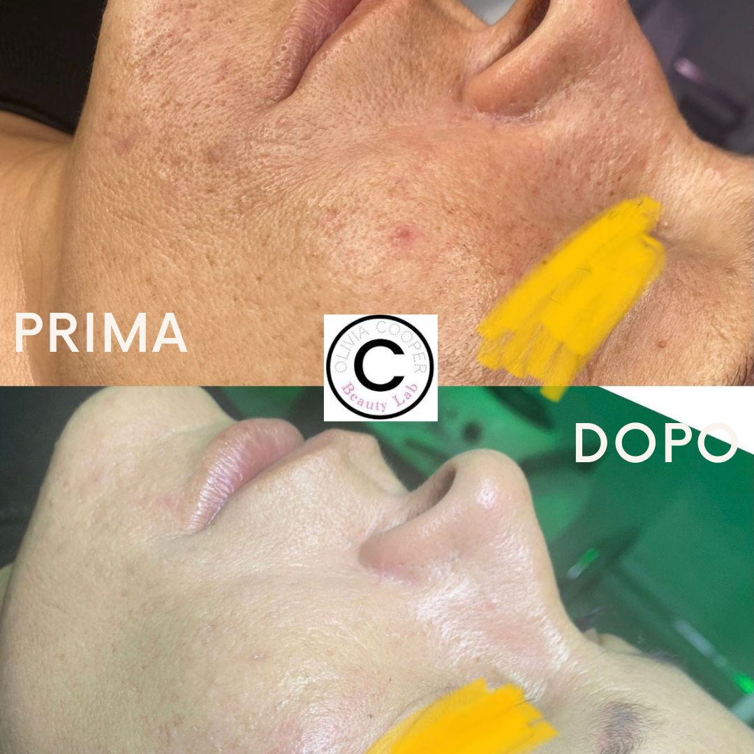 trattamento di microneedling